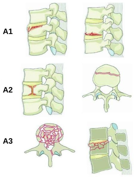 Типы компрессионного перелома позвоночника (AO Spine)