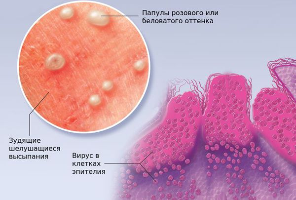Контагиозный моллюск в клетках эпителия