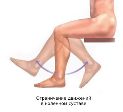 Контрактура коленного сустава