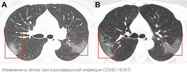 Изменения в лёгких при коронавирусной инфекции COVID-19 (снимок КТ) [22]