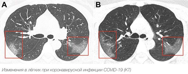Изменения в лёгких при коронавирусной инфекции COVID-19 (снимок КТ)