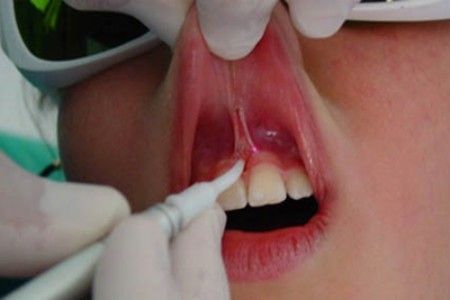 Лазерная пластика [18]