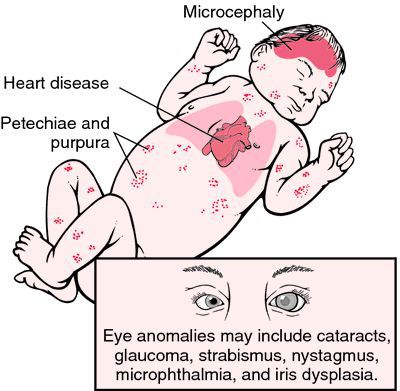Признаки врождённой краснушной инфекции