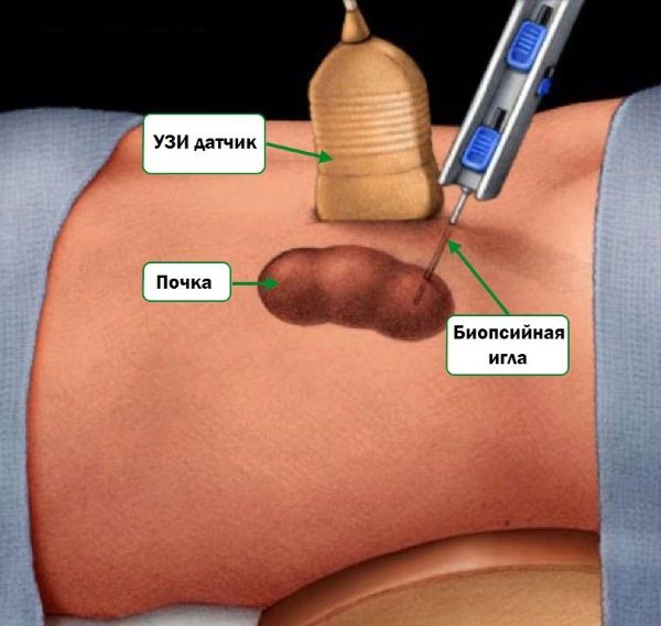 Биопсия почки