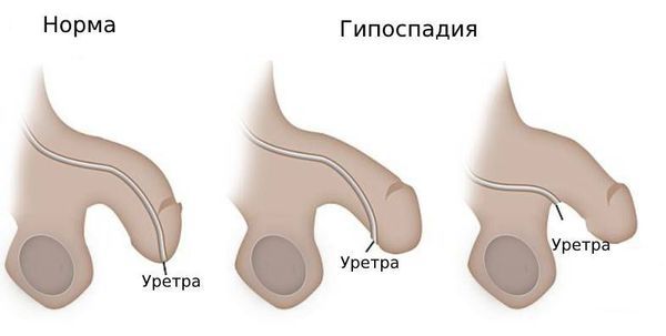 Гипоспадия Гипоспадия
