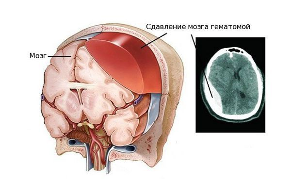 Сдавливание головного мозга