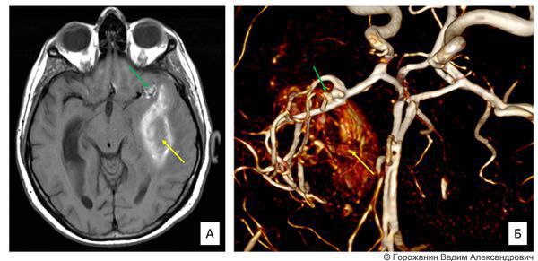 МРТ (А) и МР-ангиография (Б). Кровоизлияние из аневризмы левой средней мозговой артерии (зелёная стрелка) с образованием гематомы (жёлтая стрелка), которая проявилась речевыми нарушениями