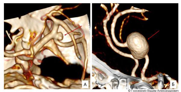 Спиральная компьютерная томография: мешотчатая (А) и веретенообразная (Б) аневризма