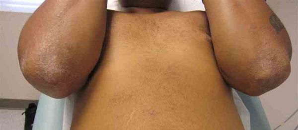 Никелевый контактный дерматит [22]