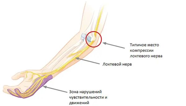 Кубитальный туннельный синдром