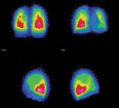 Перфузионная сцинтиграфия лёгких [21]