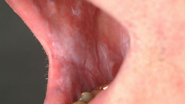 Как выглядит лейкоплакия рта