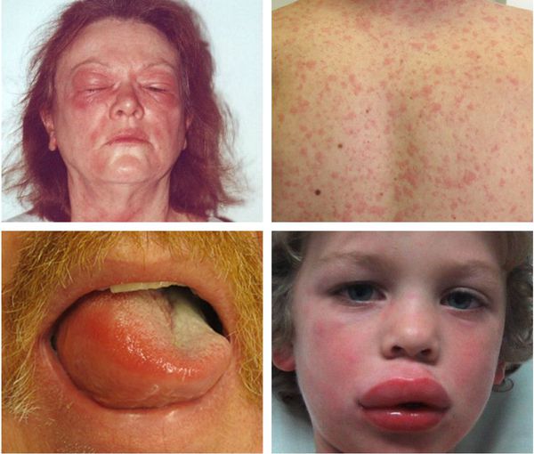 Симптомы лекарственной аллергии