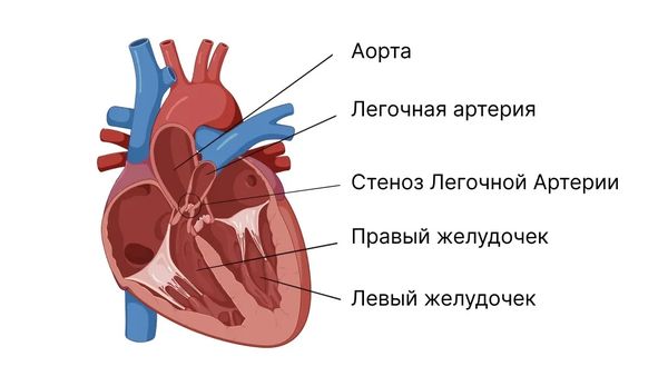 Стеноз лёгочной артерии