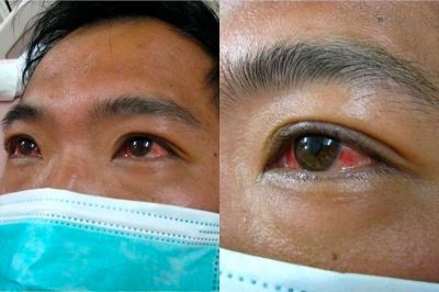 Поражённые склеры глаз при лептоспирозе