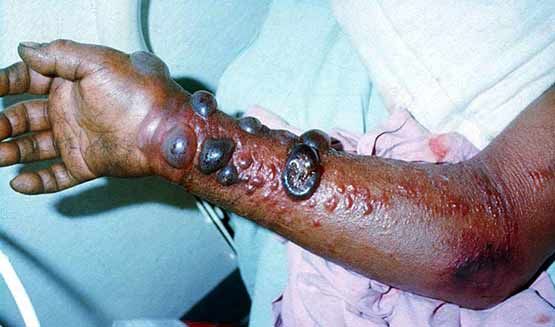 Геморрагическая сыпь [32]