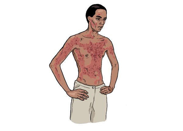 Поражение кожи при геморрагической лихорадке Эбола Поражение кожи при геморрагической лихорадке Эбола