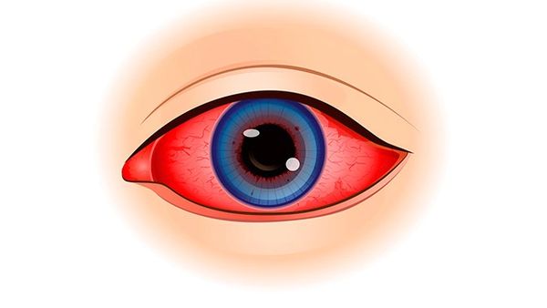 Увеит Увеит