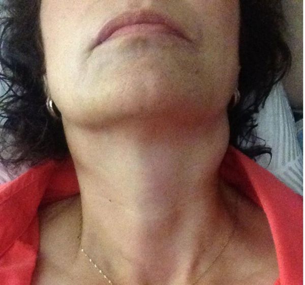 Увеличены шейные лимфатические узлы [16]