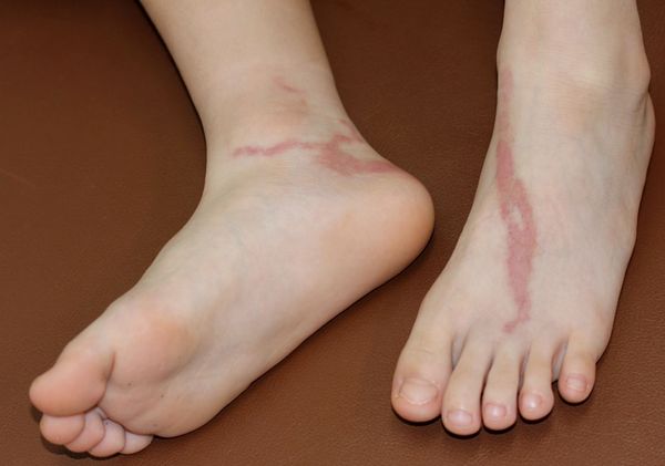 Лимфангит на ногах [18]