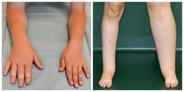 Лимфедема [19]