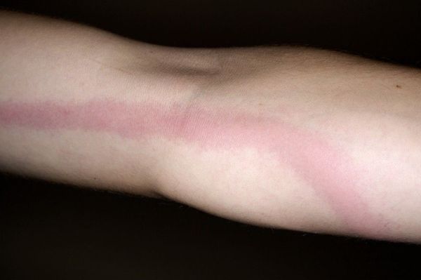 Линейное покраснение при лимфангите [17]