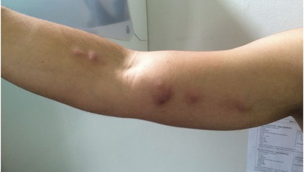 Узелковый лимфангит [13]