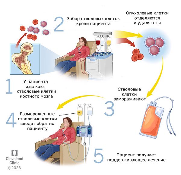 Трансплантация гемопоэтических стволовых клеток