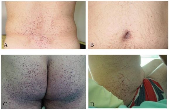 Ангиокератомы при болезни Фабри [15]