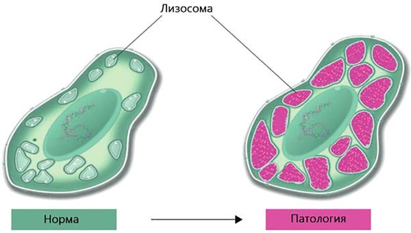 Накопление липидов в лизосомах клетки [23]