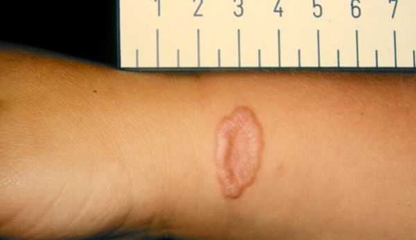 Кольцевидная гранулёма [13]