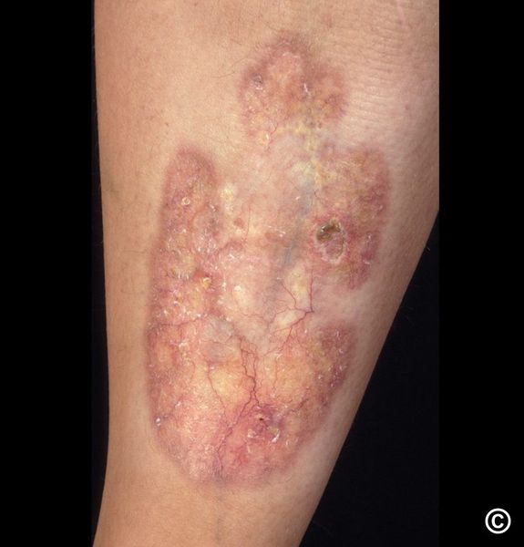 Липоидный некробиоз [14]