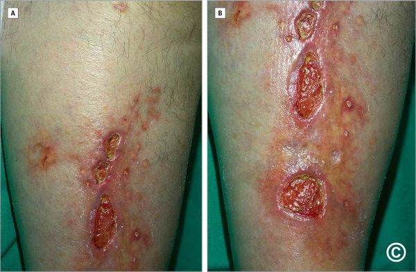 Обширные язвы при липоидном некробиозе [14]