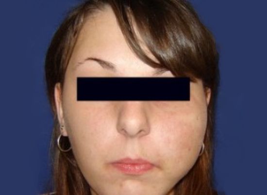 Инфильтрирующий врождённый липоматоз лица [26]