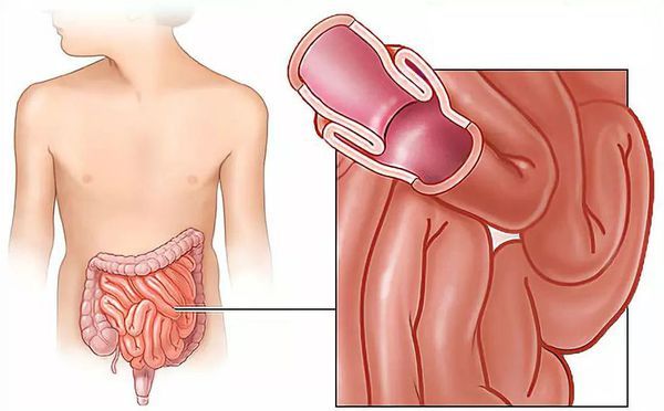 Инвагинация одной кишки в другую Инвагинация одной кишки в другую
