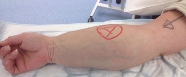 Липосаркома на предплечье [27]