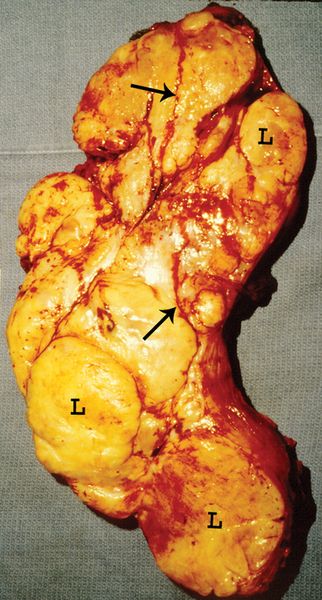 Высокодифференцированная липосаркома бедра [7]