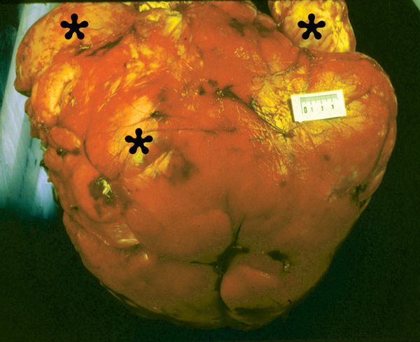  Высокодифференцированная забрюшинная липосаркома [7]