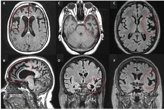 МРТ при ЛВД: А, Б — пЛВД; C, D — сППА; E, F — аППА [70]