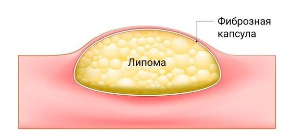 Что значит липоматоз. Жировые ловушки. Локальные жировые отложения. Липоматоз подкожной клетчатки.