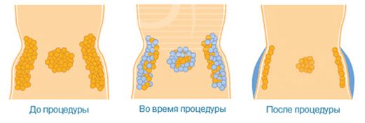 Воздействие криолиполиза на жировые клетки Воздействие криолиполиза на жировые клетки