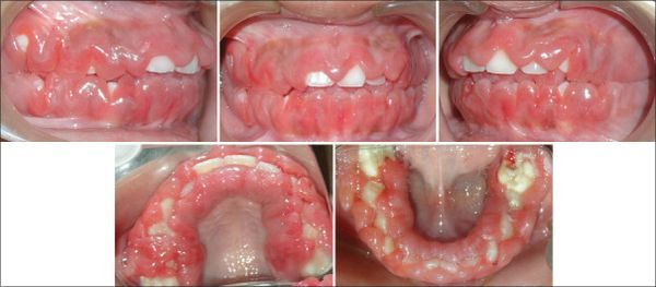 Гиперплазия обеих десён при ОМЛ [18]