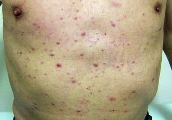 Кожные инфильтраты при ОМЛ [19]