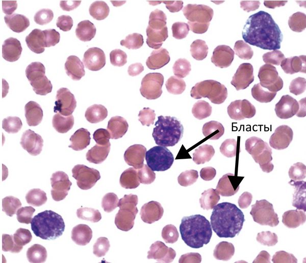 Мазок периферической крови при ОЛЛ. Он показывает мелкие, однотипные бласты с малым количеством цитоплазмы и слабо выраженными ядрышками. Окраска по Райту — Гимзе, увеличение в 100 раз [19]