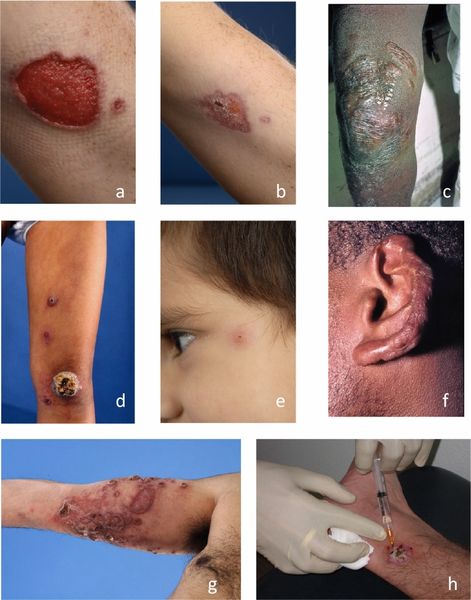 Различные проявления кожного лейшманиоза [24]