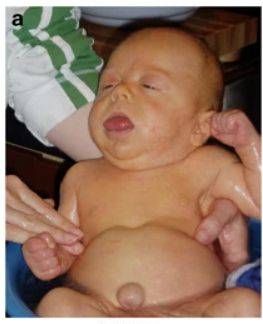 Макроглоссия и дефект брюшной стенки при синдроме Беквита — Видемана [20]