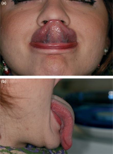 Макроглоссия у ребёнка [16]