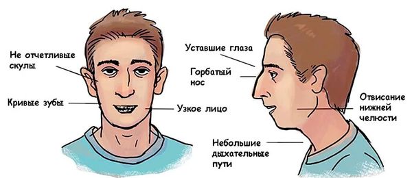 Аденоидный тип лица