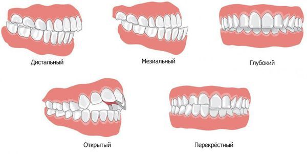 Виды прикуса