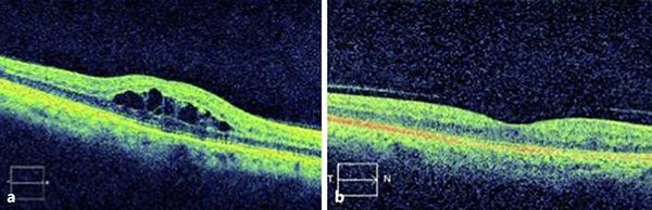 ОКТ: а — макулярный отёк, b — макула в норме [27]